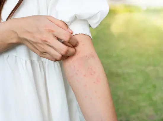 Allergic Skin Disorders