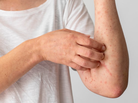Home - Atopic Dermatitis