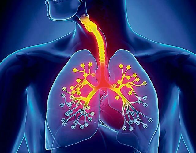 chronic bronchitis